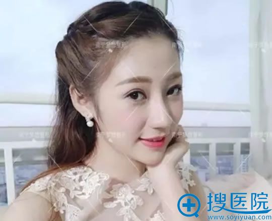 做完鼻综合和双眼皮手术2月照片 做完鼻综合和双眼皮手术2月照片