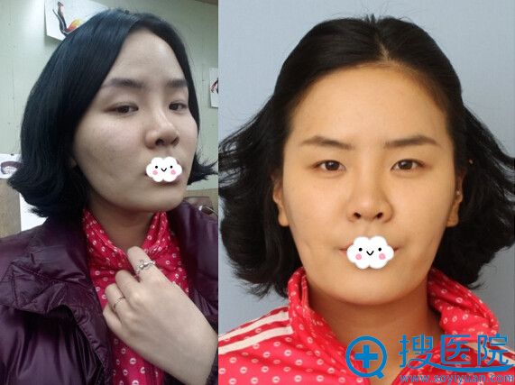 之前做的假体隆鼻失败成歪鼻 到韩国巴诺巴奇修复美的不留痕迹