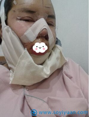 韩国巴诺巴奇双眼皮隆鼻失败修复术后效果 韩国巴诺巴奇双眼皮隆鼻失败修复术后效果