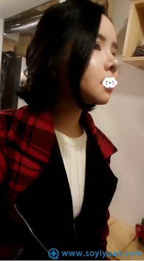韩国巴诺巴奇整形医院面部轮廓整形案例 韩国巴诺巴奇整形医院面部轮廓整形案例