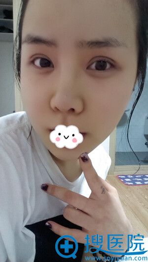 韩国巴诺巴奇整形医院瘦脸案例 韩国巴诺巴奇整形医院瘦脸案例