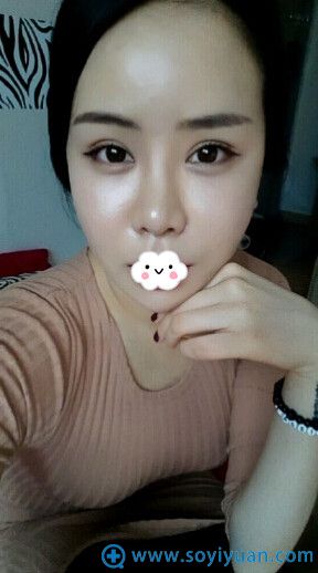 韩国巴诺巴奇整形医院双眼皮案例 韩国巴诺巴奇整形医院双眼皮案例