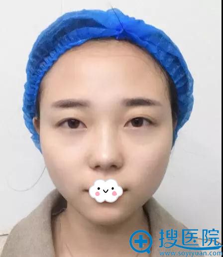 我的真实埋线双眼皮恢复案例告诉你太原时光做的好不好?