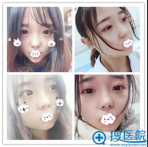 ̫ԭʱ������˫��Ƥ����Ч���Ա�