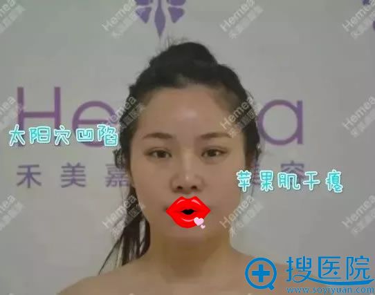 手术前太阳穴凹陷和苹果肌干瘪 手术前太阳穴凹陷和苹果肌干瘪