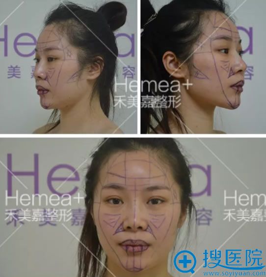 禾美嘉任学会设计脂肪填充方案 禾美嘉任学会设计脂肪填充方案