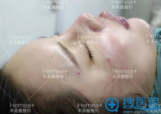 自体脂肪填充全脸术后即刻效果 自体脂肪填充全脸术后即刻效果