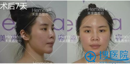 自体脂肪填充全脸7天恢复效果 自体脂肪填充全脸7天恢复效果