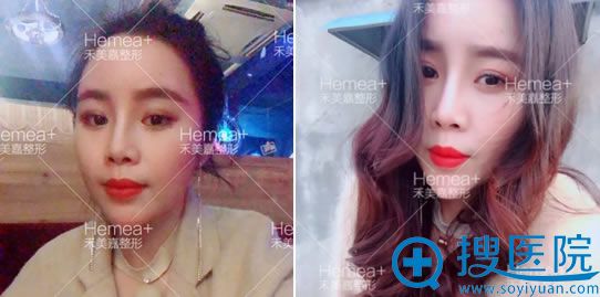 任学会自体脂肪填充案例30天效果 任学会自体脂肪填充案例30天效果