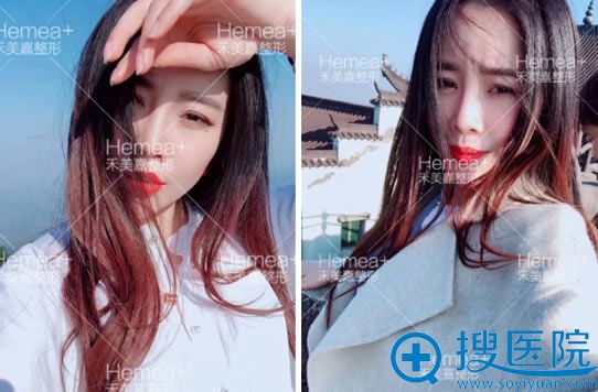 脂肪填充太阳穴和苹果肌45天效果 脂肪填充太阳穴和苹果肌45天效果