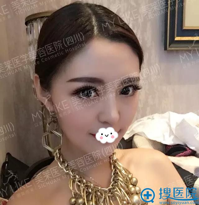 大家看四川美莱夏秋线雕+玻尿酸面部填充15天恢复效果怎么样?