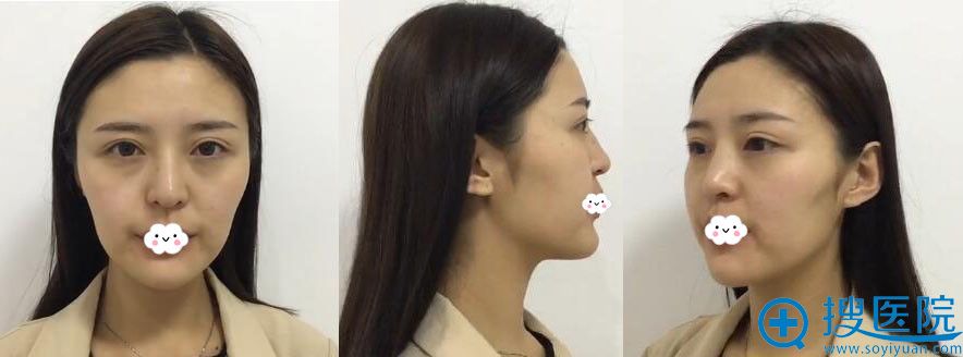 四川美莱整形面部线雕前 四川美莱整形面部线雕前