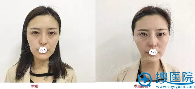 四川美莱面部线雕+玻尿酸填充术后即刻效果对比 四川美莱面部线雕+玻尿酸填充术后即刻效果对比