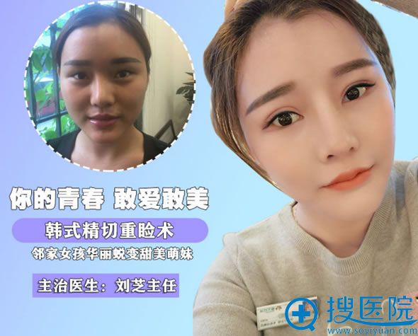 <!--<i data=20240710 data-id=12011></i>-->整形刘芝双眼皮案例 <!--<i data=20240710 data-id=12011></i>-->整形刘芝双眼皮案例