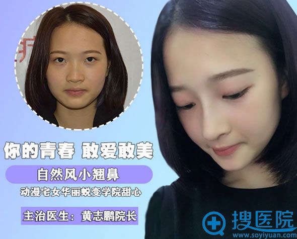 <!--<i data=20240710 data-id=12011></i>-->整形黄志鹏院长小翘鼻综合案例 <!--<i data=20240710 data-id=12011></i>-->整形黄志鹏院长小翘鼻综合案例