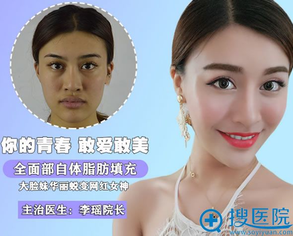 <!--<i data=20240710 data-id=12011></i>-->李瑶自体脂肪填充案例 <!--<i data=20240710 data-id=12011></i>-->李瑶自体脂肪填充案例