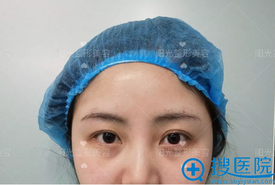 郑州阳光整形美容双眼皮术前 郑州阳光整形美容双眼皮术前
