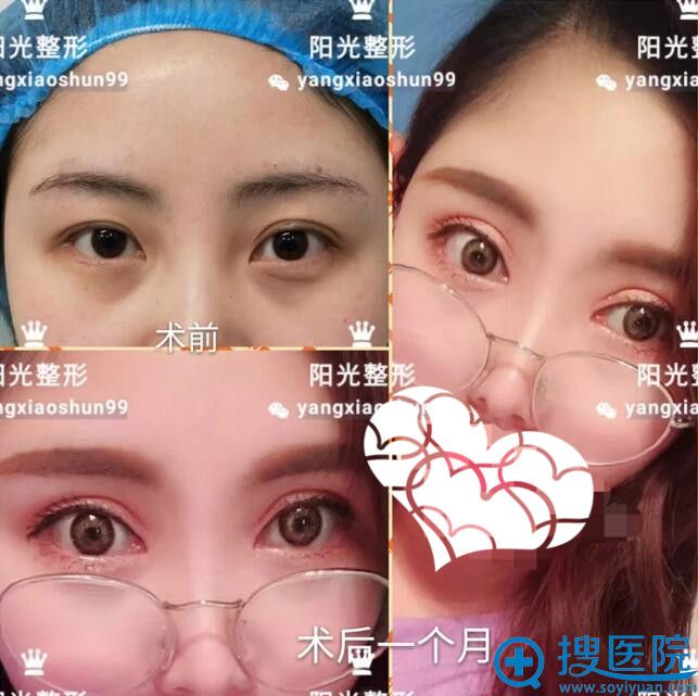 郑州阳光杨小顺双眼皮真人案例 郑州阳光杨小顺双眼皮真人案例