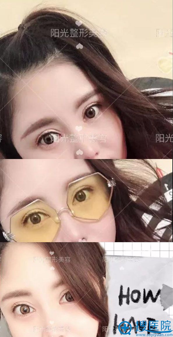 郑州阳光杨小顺双眼皮术后效果 郑州阳光杨小顺双眼皮术后效果
