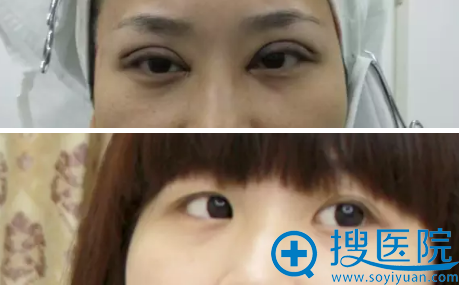 九<!--<i data=20240710 data-id=16293></i>-->美徐魁做双眼皮怎么样?看案例对比图 九<!--<i data=20240710 data-id=16293></i>-->美徐魁做双眼皮怎么样?看案例对比图