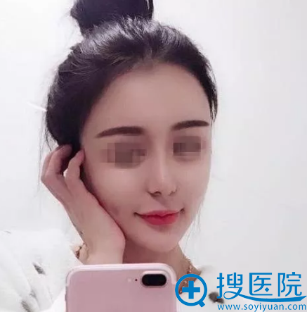 <!--<i data=20240710 data-id=11757></i>-->鼻综合隆鼻五天恢复效果图 <!--<i data=20240710 data-id=11757></i>-->鼻综合隆鼻五天恢复效果图