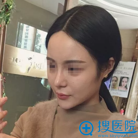 <!--<i data=20240710 data-id=11757></i>-->鼻综合隆鼻案例素颜照片 <!--<i data=20240710 data-id=11757></i>-->鼻综合隆鼻案例素颜照片