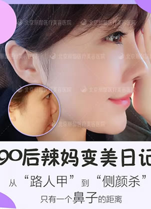 90后辣妈在北京丽都找闵英俊医生做过鼻综合术后100天的照片