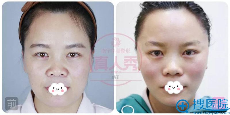 南宁华美线雕真人对比案例 南宁华美线雕真人对比案例