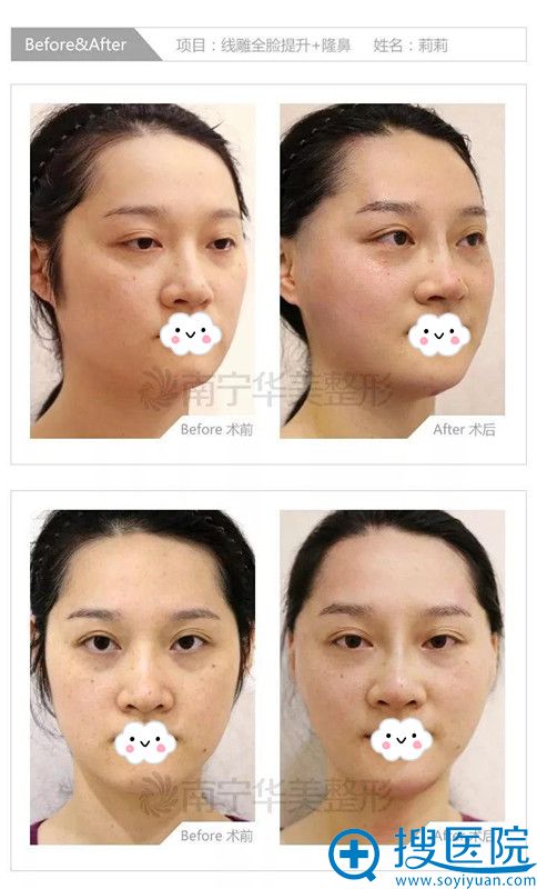 南宁华美线雕术前术后真实对比 南宁华美线雕术前术后真实对比