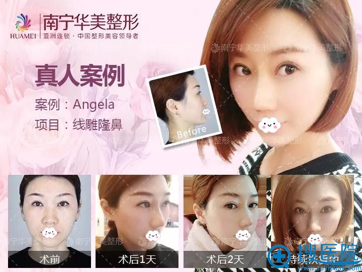 南宁华美线雕恢复过程案例展示 南宁华美线雕恢复过程案例展示