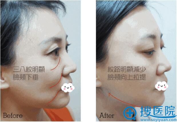 宿译元线雕前后真人案例效果对比 宿译元线雕前后真人案例效果对比
