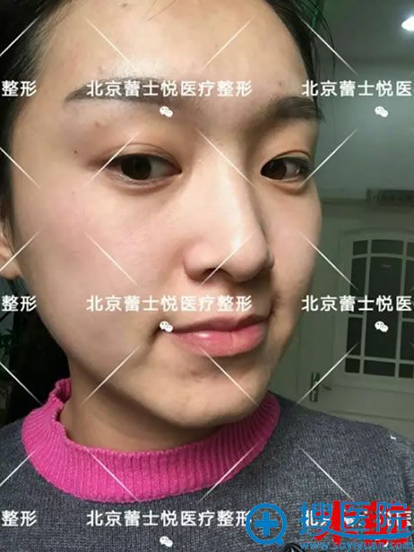 婷婷做面部脂肪填充和双眼皮之前 婷婷做面部脂肪填充和双眼皮之前