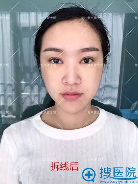 切开双眼皮和开眼角拆线后<span style= 切开双眼皮和开眼角拆线后<span style=