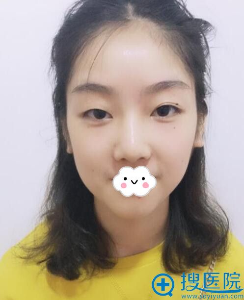 武汉美天陈耀文双眼皮术前 武汉美天陈耀文双眼皮术前