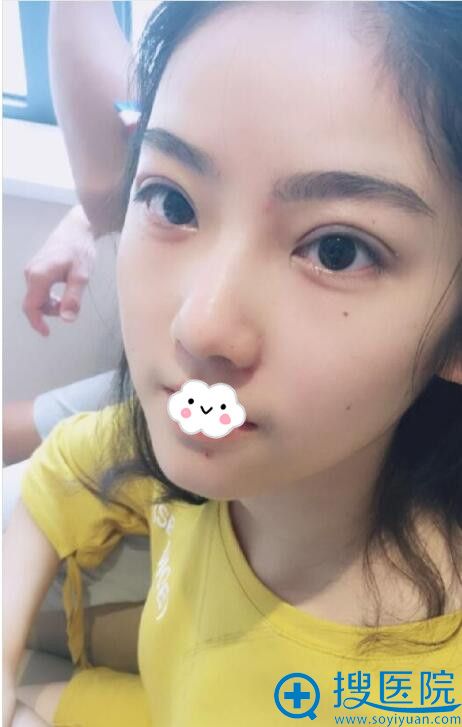 武汉美天陈耀文双眼皮真人案例 武汉美天陈耀文双眼皮真人案例