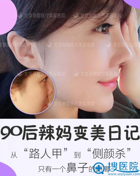 90后辣妈鼻综合手术变美日记 90后辣妈鼻综合手术变美日记