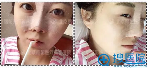 北京丽都鼻综合手术后1天照片 北京丽都鼻综合手术后1天照片