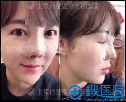 在丽都找<!--<i data=20240710 data-id=16598></i>-->做鼻综合3天照片 在丽都找<!--<i data=20240710 data-id=16598></i>-->做鼻综合3天照片