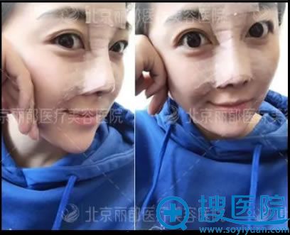 丽都鼻综合术后7天的照片 丽都鼻综合术后7天的照片