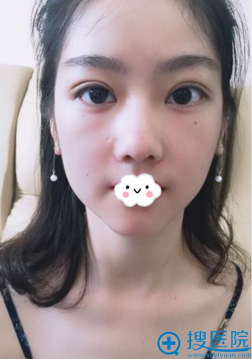 武汉美天医疗美容门诊部陈耀文精切双眼皮 武汉美天医疗美容门诊部陈耀文精切双眼皮