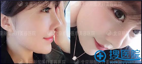 北京丽都鼻综合术后15天的照片 北京丽都鼻综合术后15天的照片