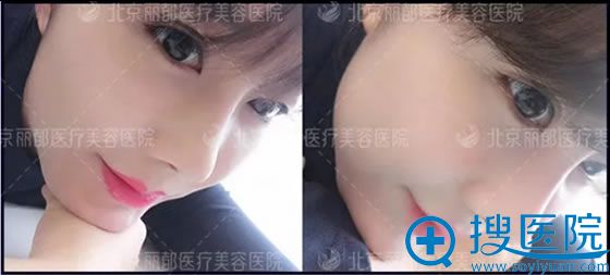 找<!--<i data=20240710 data-id=16598></i>-->医生做鼻综合术后20天的照片 找<!--<i data=20240710 data-id=16598></i>-->医生做鼻综合术后20天的照片