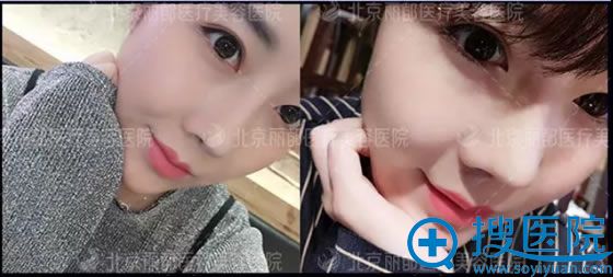 北京丽都找<!--<i data=20240710 data-id=16598></i>-->做鼻综合术后65天照片 北京丽都找<!--<i data=20240710 data-id=16598></i>-->做鼻综合术后65天照片