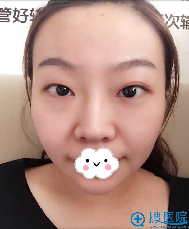 青睐美丽大眼的信阳东方艺员工割了双眼皮美丽蝶变效果图