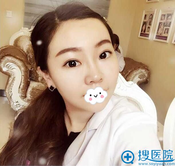 信阳东方艺割双眼皮术后效果 信阳东方艺割双眼皮术后效果