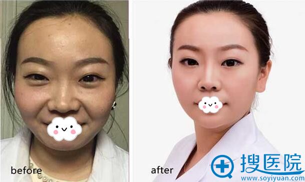 信阳东方艺双眼皮前后真人案例对比 信阳东方艺双眼皮前后真人案例对比