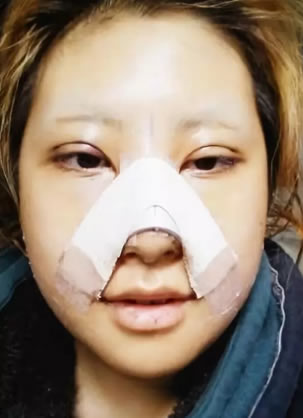 是时候展示恢复效果了 韩国巴诺巴奇轮廓三件套+眼鼻整形7个月