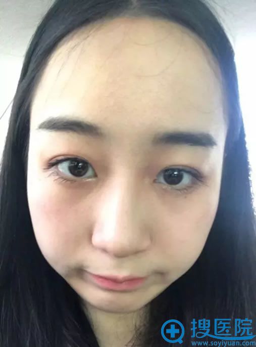 在壹美注射前的大脸照片 在壹美注射前的大脸照片
