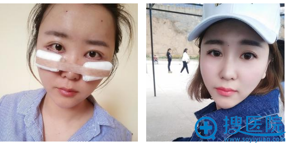 刚在<!--<i data=20240710 data-id=9134></i>-->做完自体脂肪填充的样子 刚在<!--<i data=20240710 data-id=9134></i>-->做完自体脂肪填充的样子