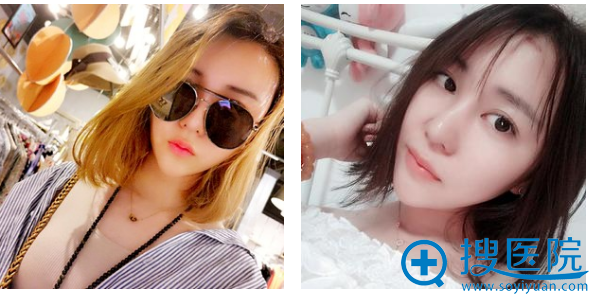<!--<i data=20240710 data-id=16637></i>-->亮自体脂肪填充案例25天效果图 <!--<i data=20240710 data-id=16637></i>-->亮自体脂肪填充案例25天效果图
